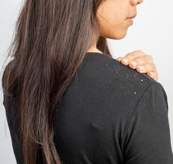 Trị Gàu Bằng Dầu Dừa Vừa Tốt Vừa Rẻ [Chia Sẻ]